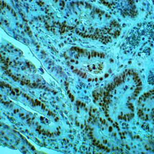 Immunohistochenstry staining of paraffin-embedded human colon cancer tissue 1st antibodies: mouse Anti-MLH1 2nd antibodies: biotinylated goat anti-rabbit/anti-mouse IgG (ICP2481) 3rd antibodies: goat anti-biotin, HRP polymer (ICP2489)